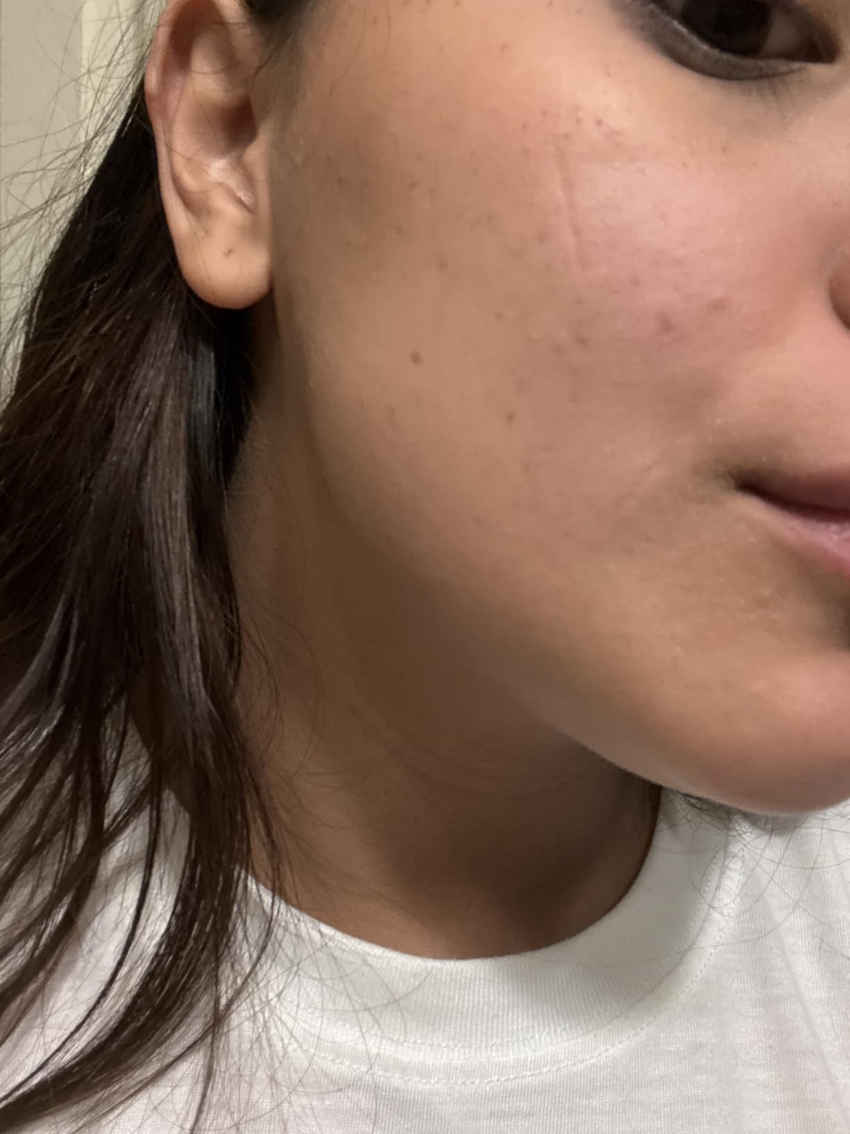 La Roche-Posay Effaclar Salicylic Acid Acne Serum Treatment Pore Minimizer customer photo 1