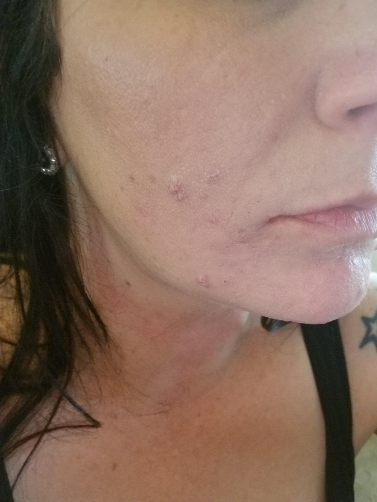 AcneFree Severe Acne 24 Hour Clearing System for stubborn acne, 4 Step Routine Kit customer photo 2