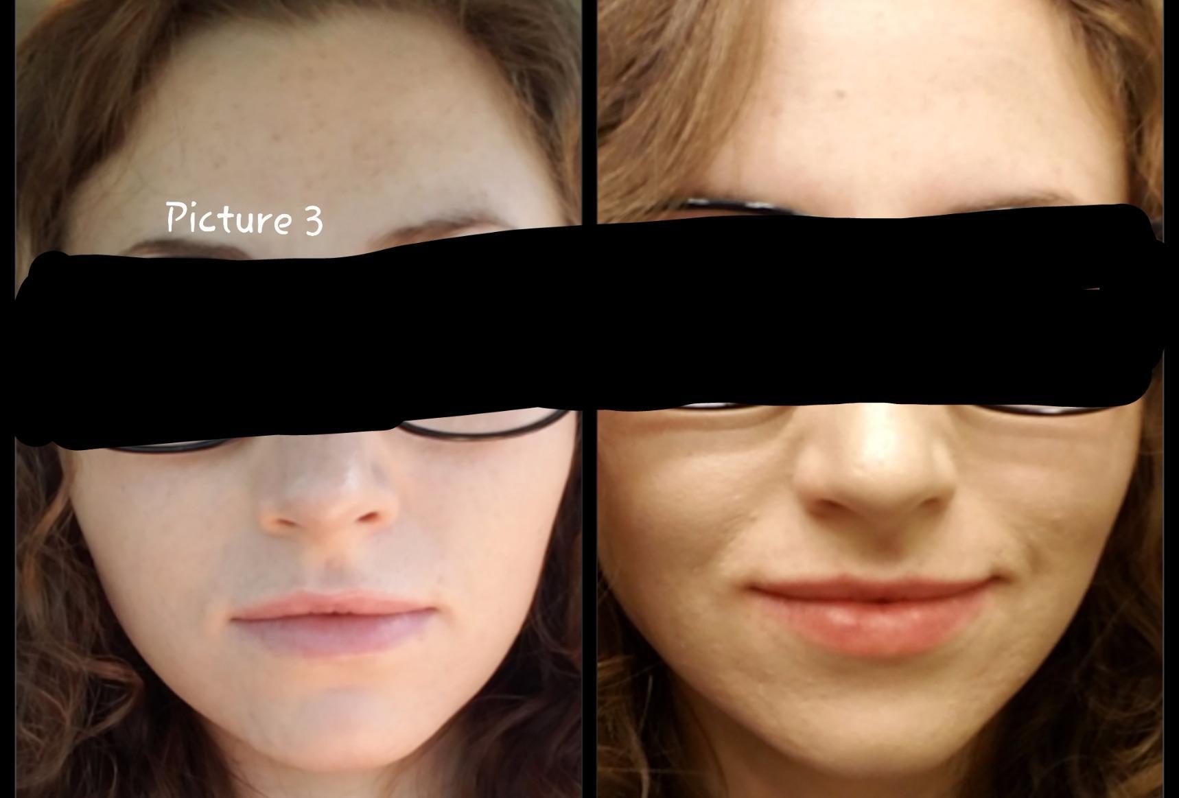 CeraVe Renewing Salicylic Acid Cleanser, BHA Exfoliating Face Wash, 8oz customer photo 2