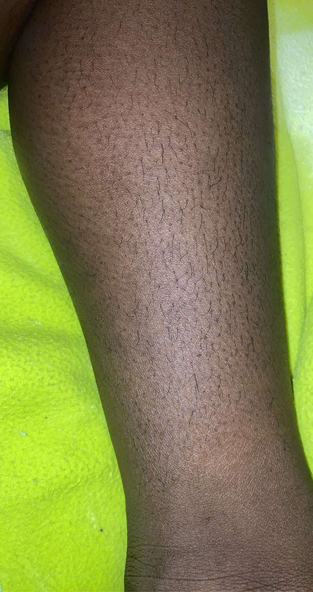 Sugaring Hair Removal Kit by Sugaring NYC - For Home Use customer photo 1
