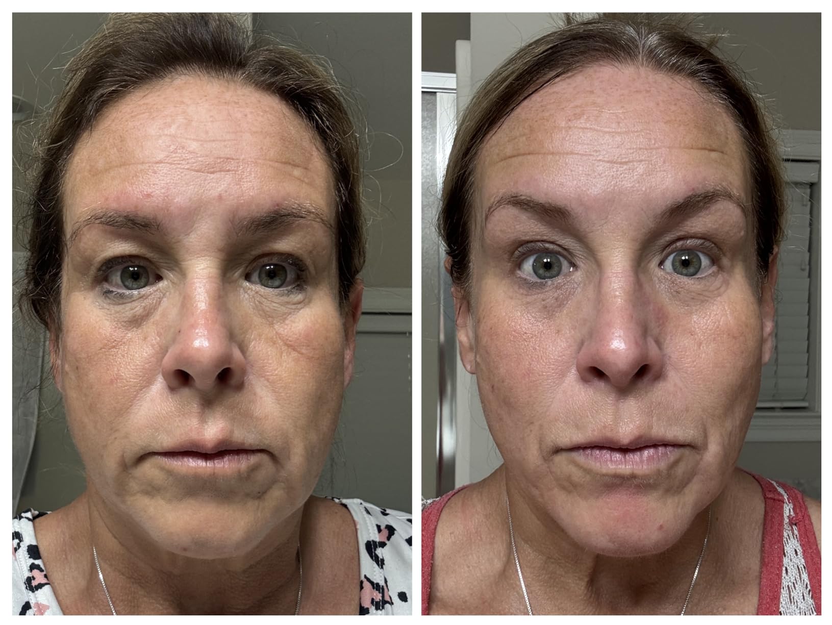 Matrixyl 10% + Hyaluronic Acid, Anti-Aging Serum for Fine Lines and Wrinkles, 1 Fl Oz customer photo 1