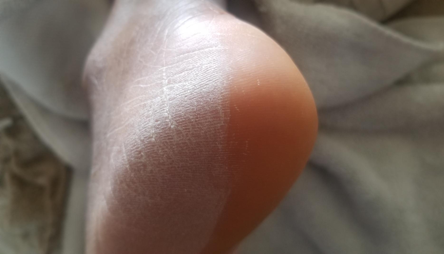 Tip2Toe Professional Electric Callus Remover customer photo 1
