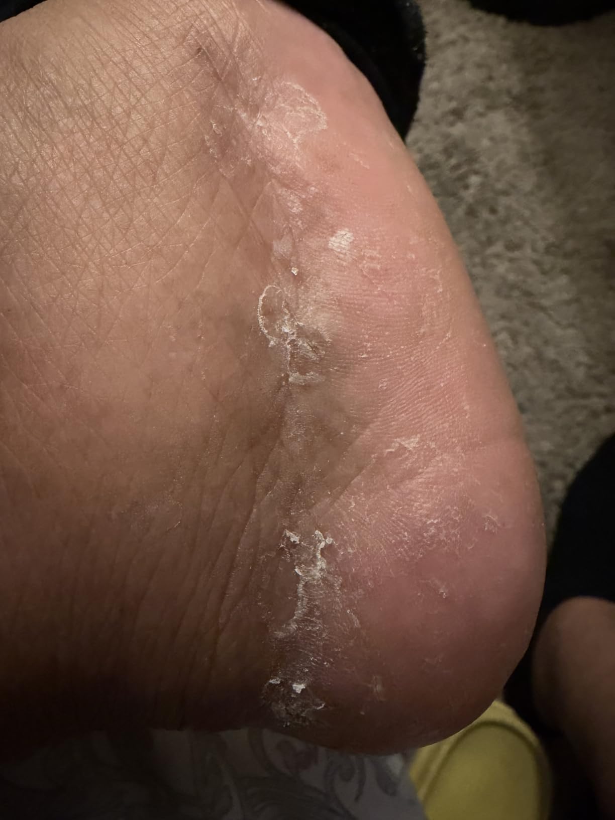 Ebanel Urea Cream 40% plus Salicylic Acid 2% for Dry Cracked Feet Skin | Deeply Moisturizes & Softens Dry Cracked Heels, Feet, Knees, Elbows, Hands, Rough Dead Skin Callus Remover Toenail Softener customer photo 2