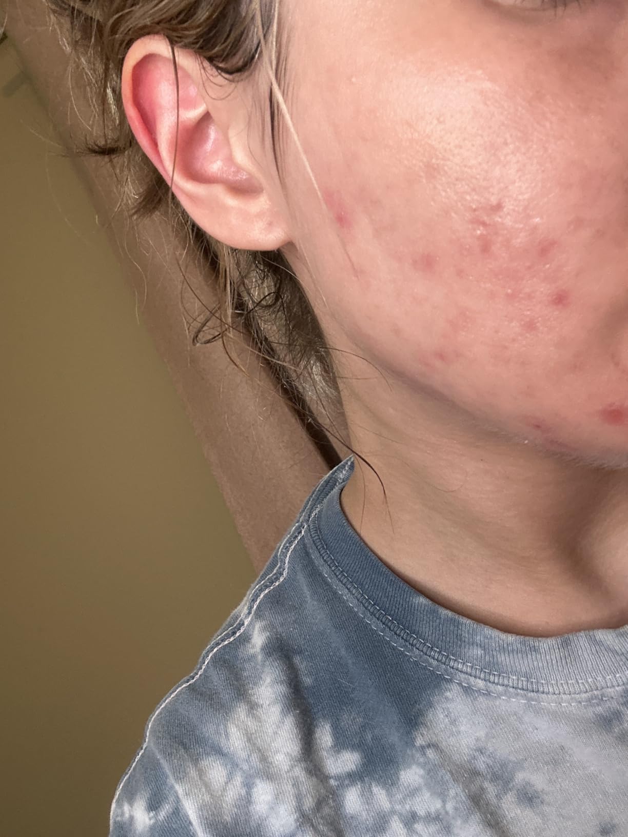 Naturium Azelaic Topical Acid 10% Serum, Niacinamide & Vitamin C, 1 fl oz | Exfoliating Skincare, Reducing Redness, Improving Skin Tone, Texture & Radiance, for Sensitive and Oily Types, Travel Size customer photo 1