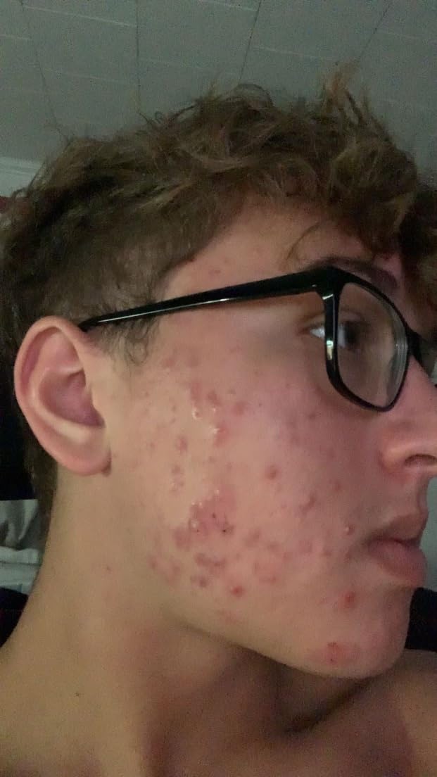 Exposed Skin Care 5-Piece Acne Treatment Kit customer photo 1