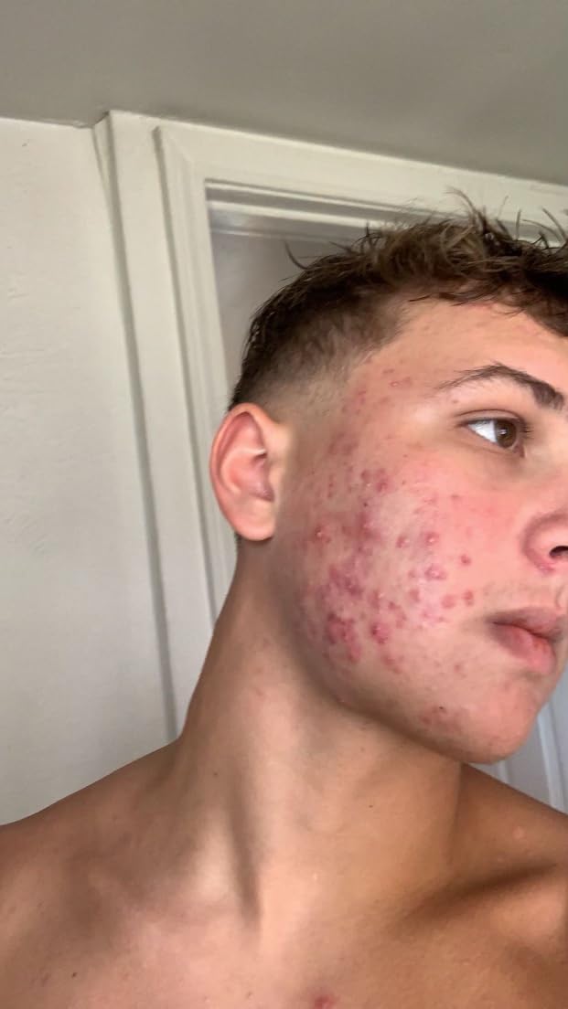 Exposed Skin Care 5-Piece Acne Treatment Kit customer photo 2