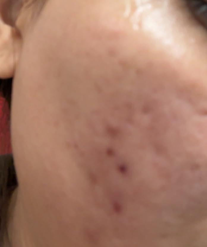 The Ordinary Salicylic Acid 2% Solution, Acne-Fighting Serum for Blemish-Prone Skin customer photo 1