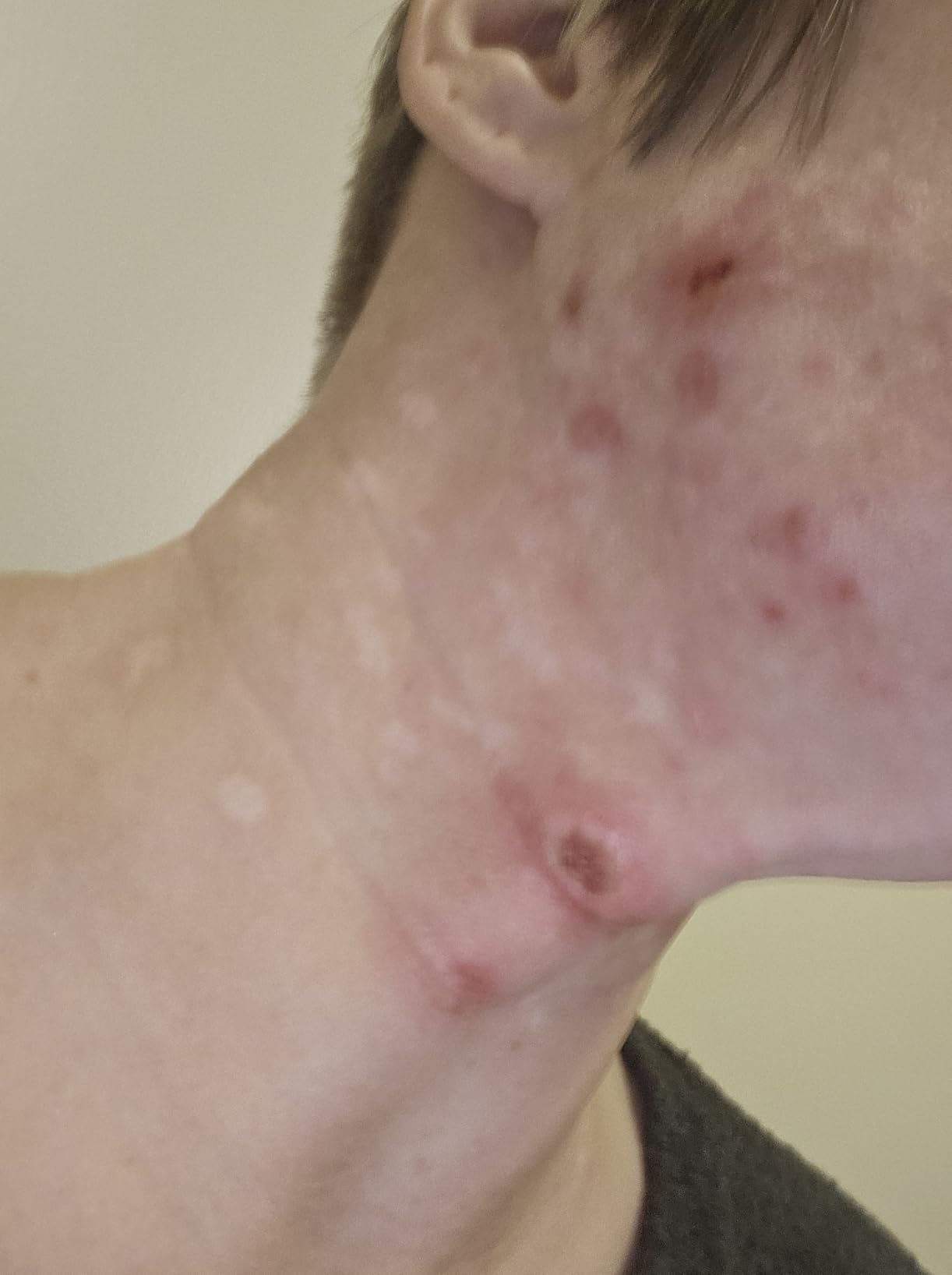 Differin Acne Kit, Adapalene Gel 0.1% + Benzoyl Peroxide Body Wash customer photo 2