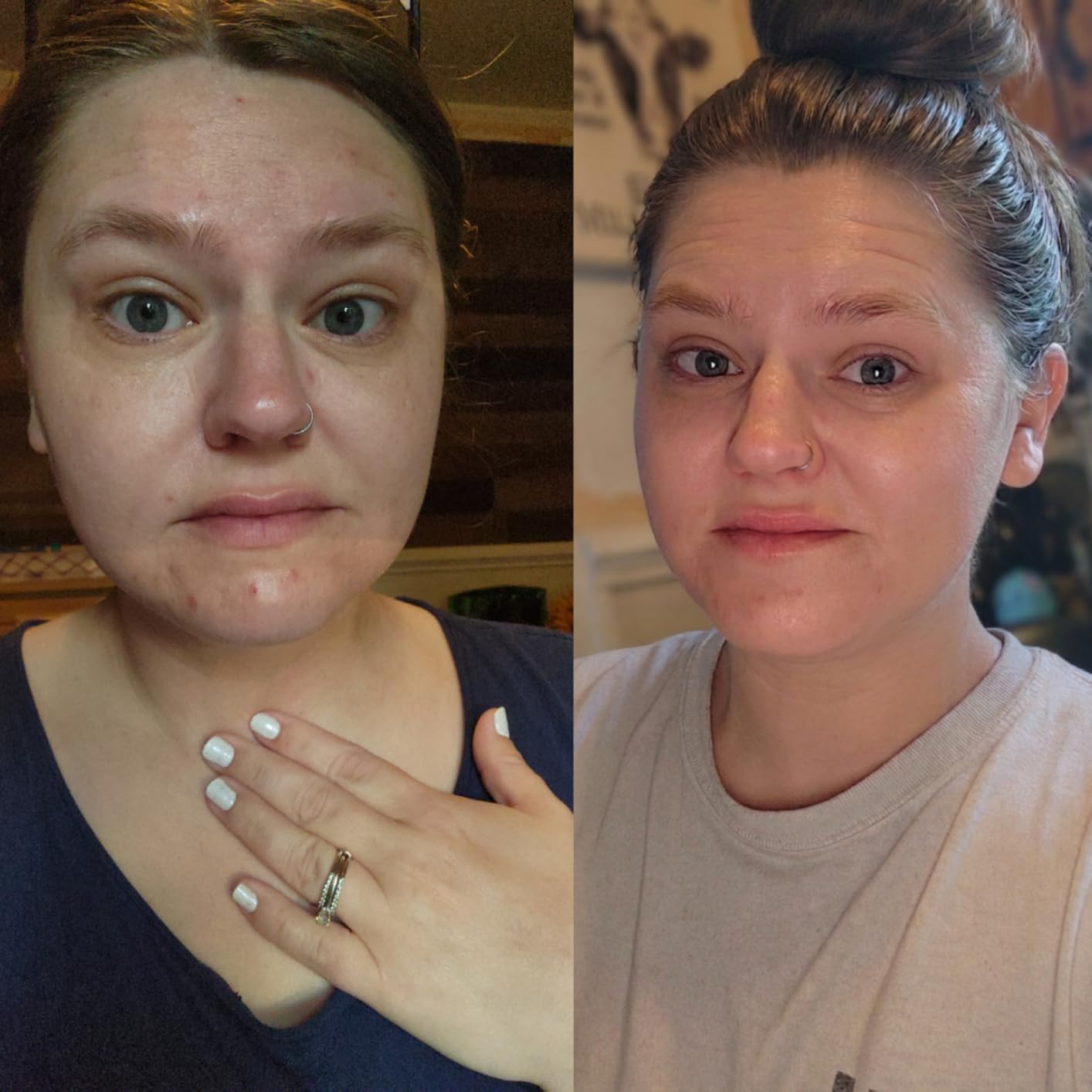 The Ordinary The Acne Set, 3-Step Skin Regimen with Glucoside Foaming Cleanser, Salicylic Acid 2% Solution, and Natural Moisturizing Factors + Beta Glucan | Skin Care Set customer photo 2