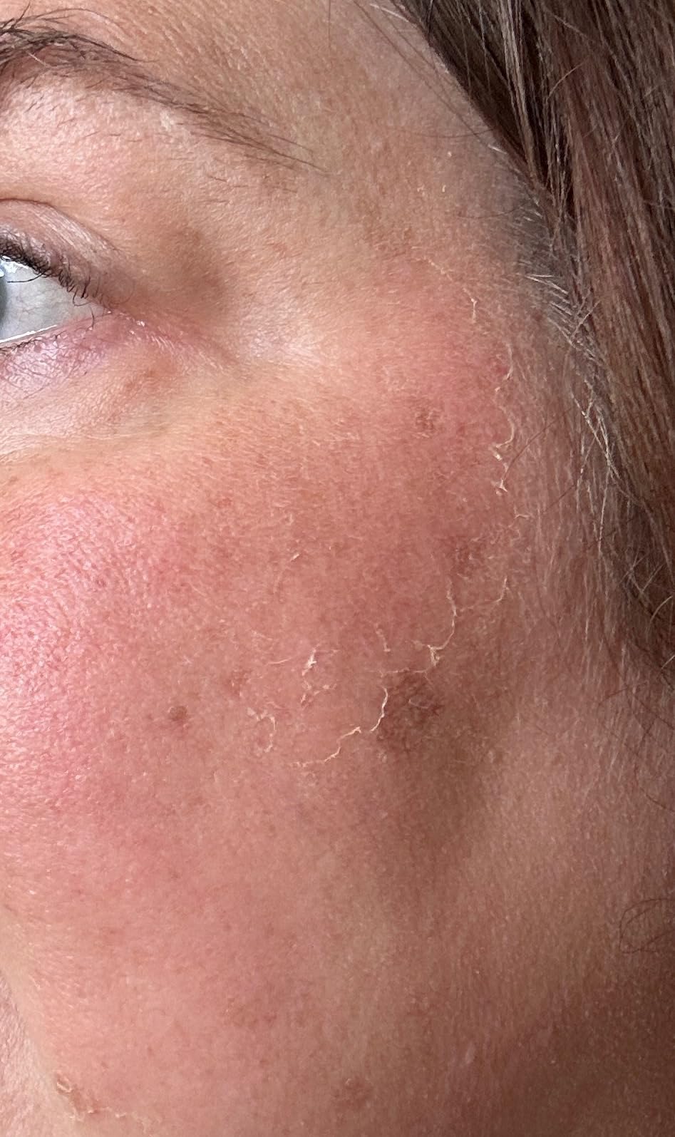 L'Oreal Paris Bright Reveal Dark Spot Exfoliant Peel, 25% AHA BHA PHA Face Exfoliator Solution, Gentle Skincare to Visibly Reduce Dark Spots and Renew Skin Texture, Includes SPF Lotion Sample customer photo 1
