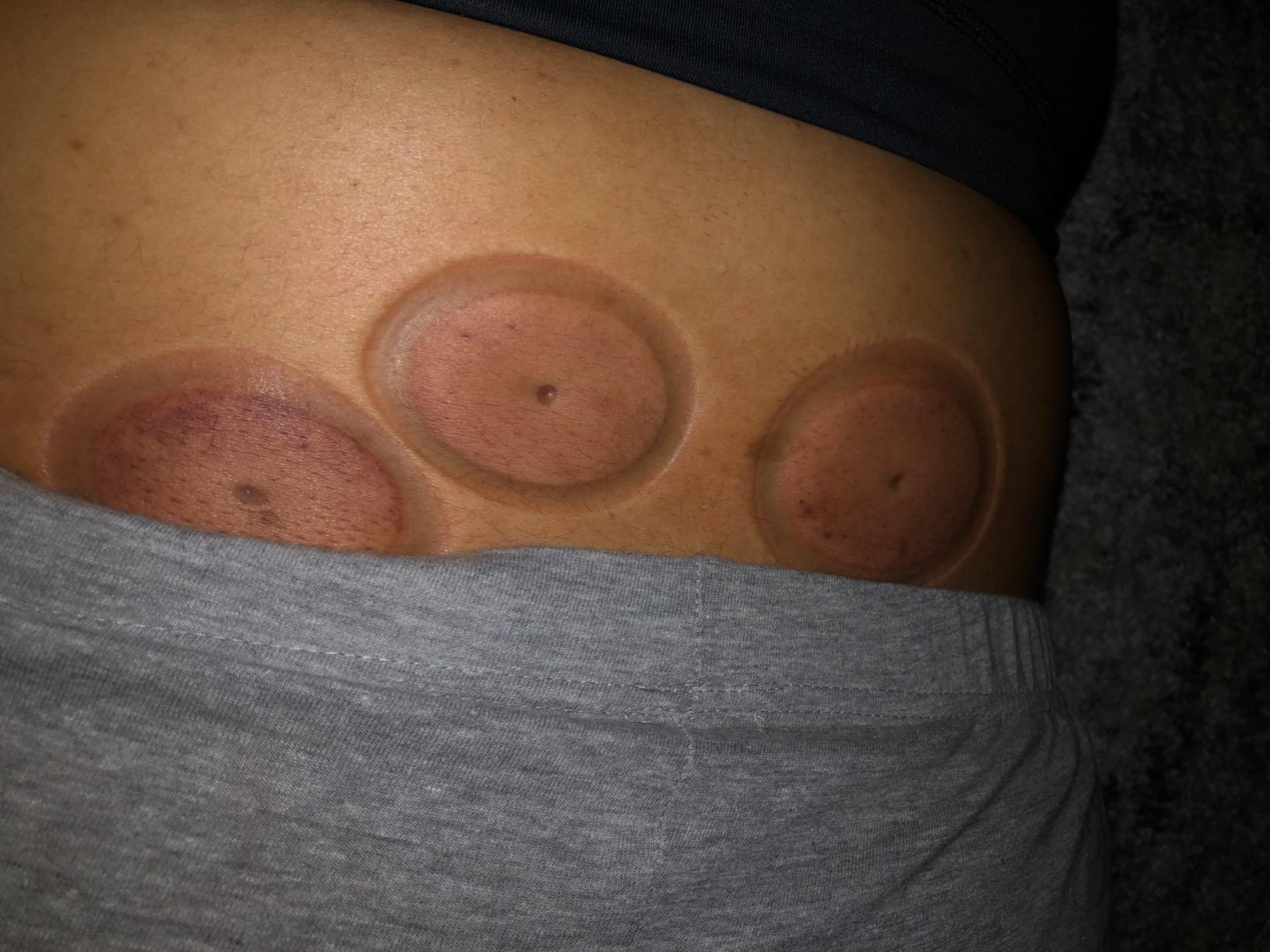 Cupping Kit for Massage Therapy Set with Pump 12 Massage Cups for Cellulite Reduction Muscle Back Pain Relief Physical Therapy customer photo 1